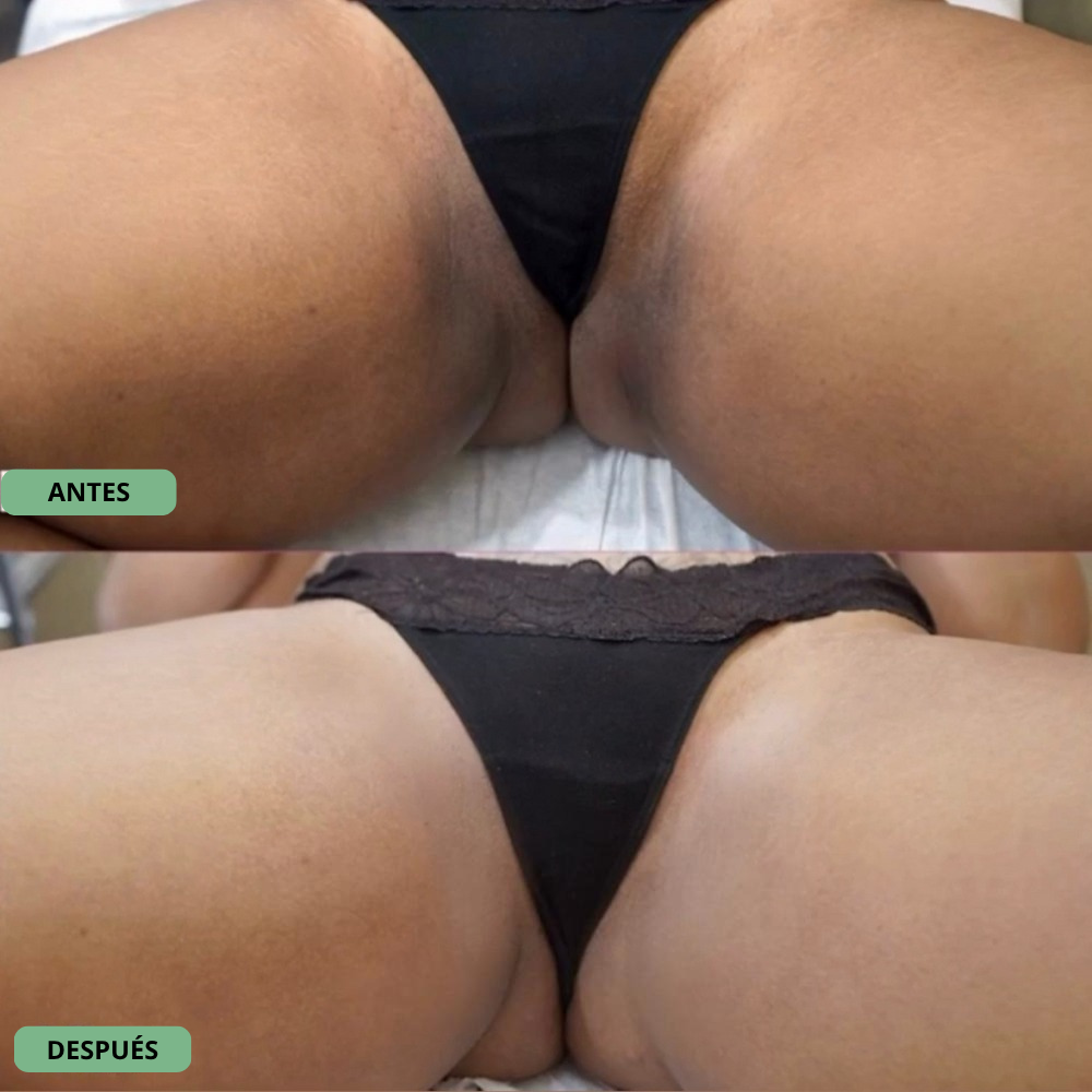 Procedimientos de Ginecología Estética con Láser
