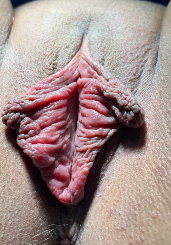 Antes Labioplastia Caso 1