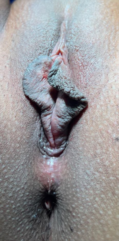 Antes Labioplastia Caso 2