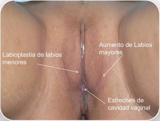Procedimientos de Ginecología Estética con Láser