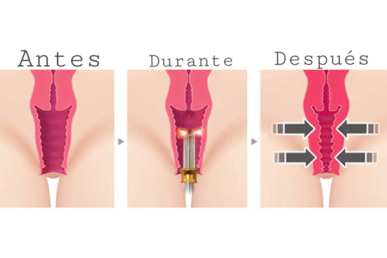 Procedimientos de Ginecología Estética con Láser
